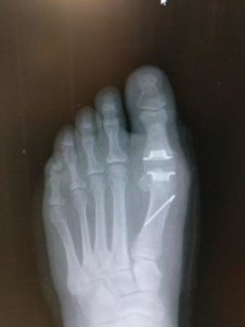 big toe Joint Replacement of the great toe joint recovery time
