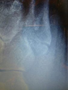 5th metatarsal Jones fracture