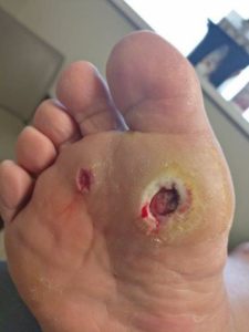 Big toe joint ulcer charcot marie tooth disease with pain needs surgery