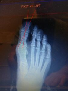 big toe joint hallux valgus interphalangeus