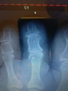 Chipped bone in the foot or shin treatment