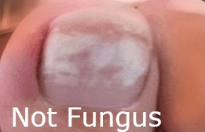 White Chalky Toenails after toenail polish