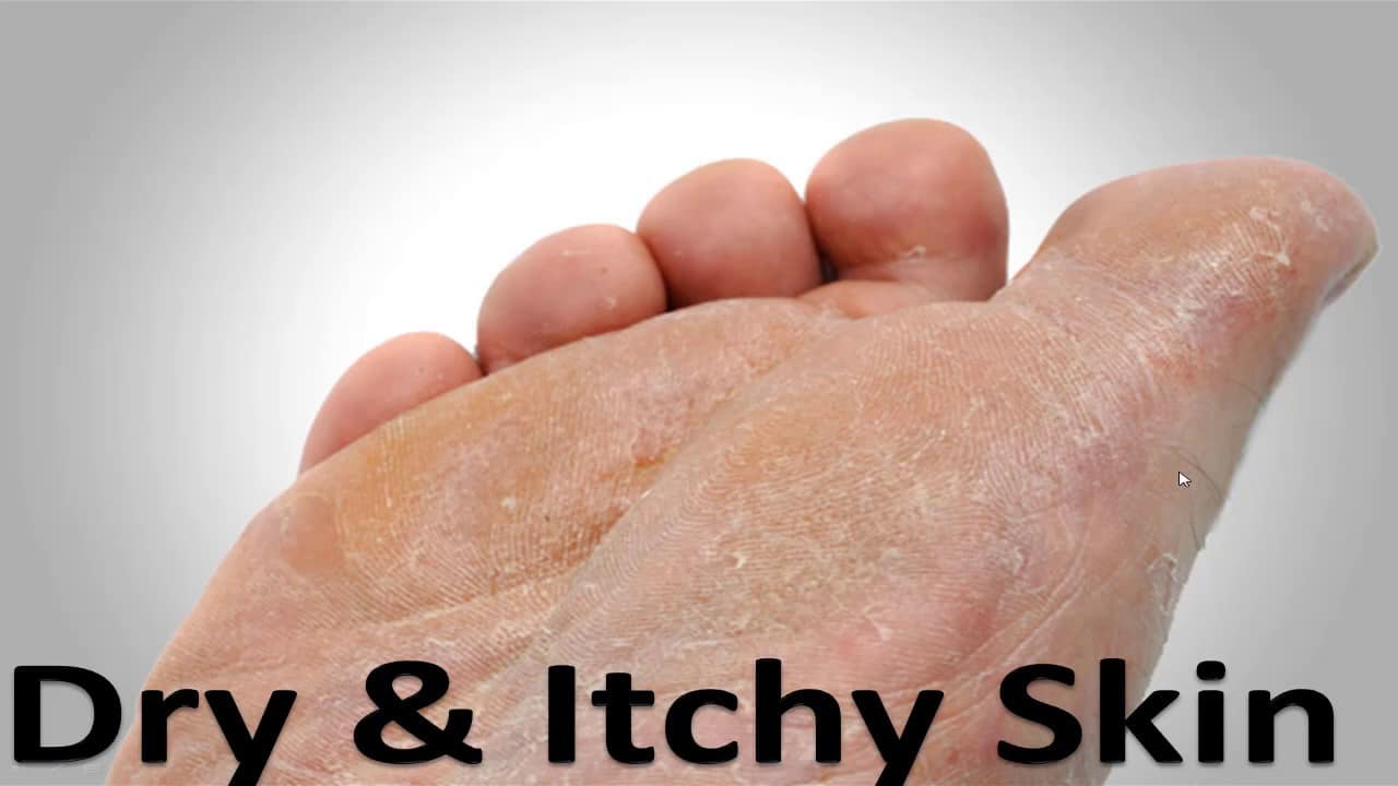 dry itchy foot skin