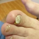Recommended Foot Doctor Products 5 Keratin granulations and big toenail fungus.
