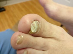 Keratin granulations and big toenail fungus.