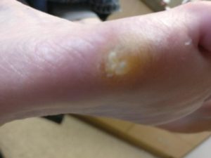 wart callus to the bottom of the foot verruca