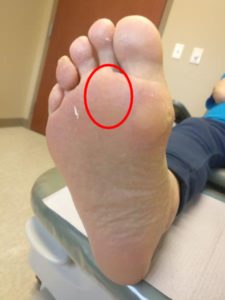 2nd toe pain (second toe) capsulitis home treatment