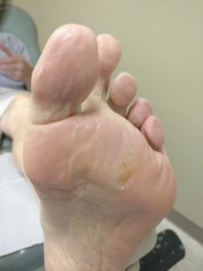 Ball of the foot plantar fat pad atrophy