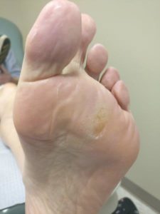 Athlete's Foot Fungus Apple Cider Vinegar Cure: