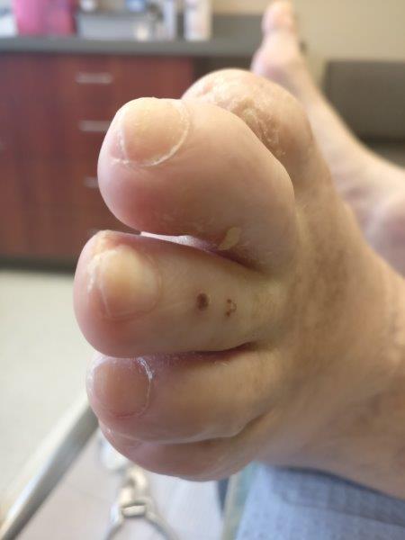White Patches On Toenails [Causes, Signs & Best Treatment]