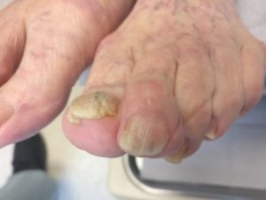 white superficial onychomycosis and toenail fungus