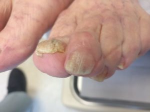 How to Fix Severe Toenail Fungus!