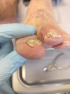 Severe Toenail Fungus Following Trimming and Cutting