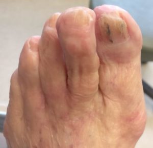 Diseases of the toenails and fingernails: White and black toenails