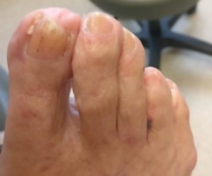 Keratin Granulations with white spots on toenails