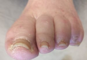 Listerine For Toenail Fungus: