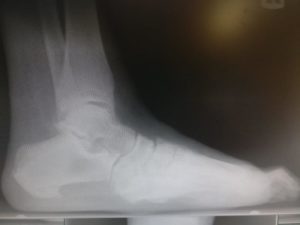 Heel Spur Surgery Recovery Time Healing Time