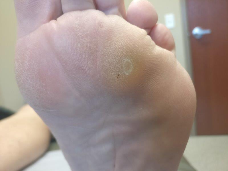 Foot Corn Removal — Bottom of Foot Callus Removal