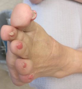 Does Wearing Nail Polish Cause Toenail Fungus?