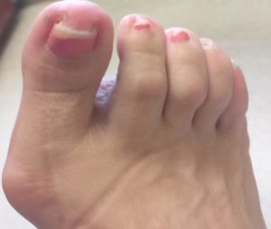 Keratin Granulations or Nail Fungus?