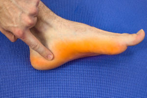 Athlete's foot fungus mocassin distribution and bottom of the heel