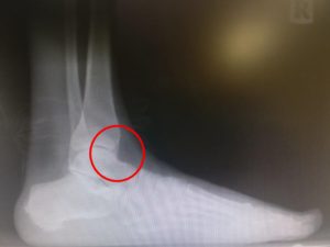 Chipped ankle bone causes, symptoms and treatment