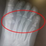 Metatarsalgia ball of the foot pain
