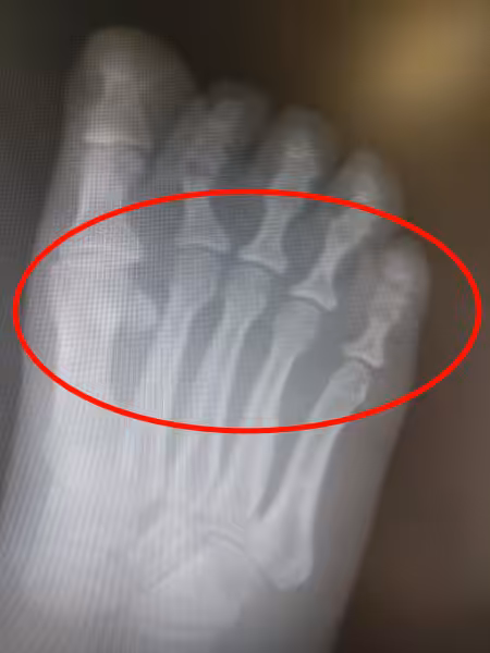 Metatarsalgia ball of the foot pain