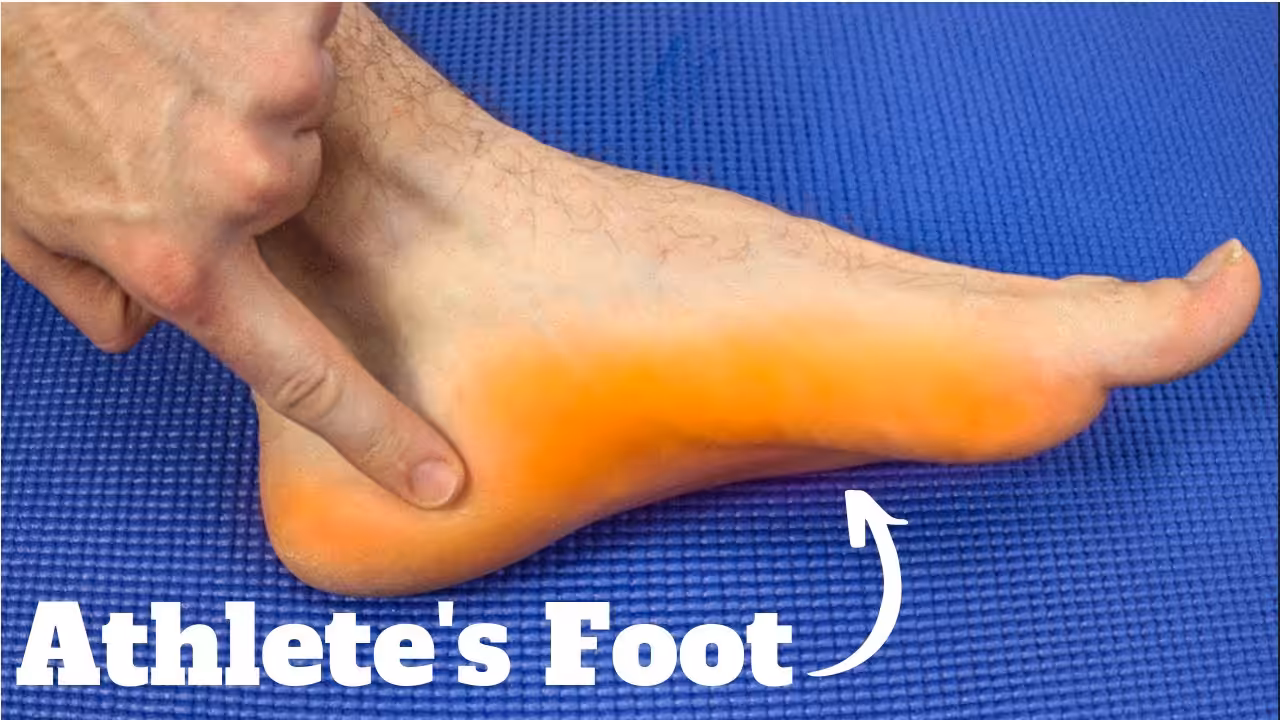 Severe Athlete&rsquo;s Foot Treatment