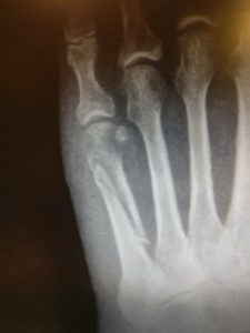 5th metatarsal fracture oblique midshaft