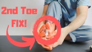 taping for capsulitis of the second toe