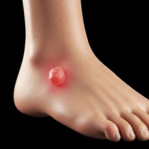 Foot Ankle Granuloma 4 Granuloma