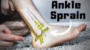 Ankle Sprain! Treatment