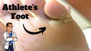 Dry Feet or Athlete's Foot