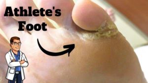 Dry Feet 1 Dry Feet or Athlete's Foot