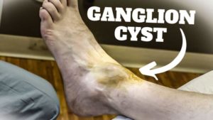 ganglion cyst