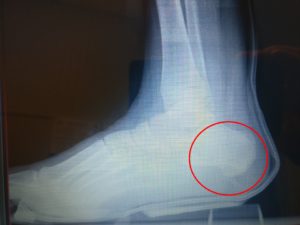 Broken Heel Bone Fracture: Causes & Best Home Treatment 2020!