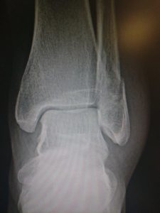 Broken Ankle Rehab for broken fibula