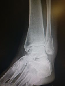 Broken fibula fracture broken ankle 