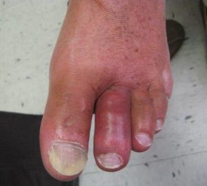 Gout of the big toe joint and the 2nd toe joint