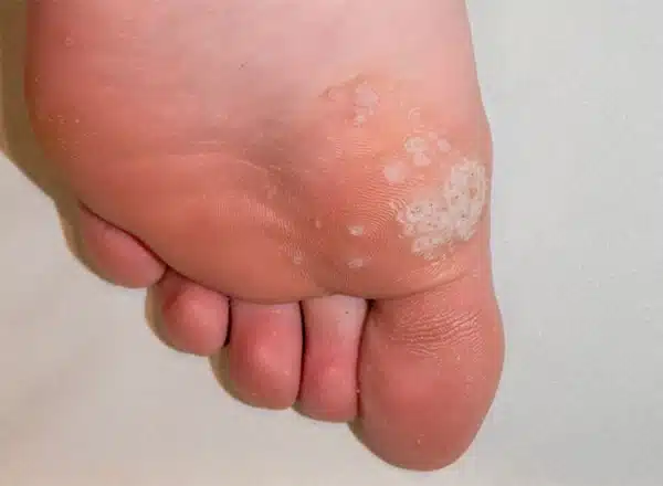 Close-up of a plantar wart on the side of a patient's big toe being examined, highlighting the need for professional removal at Michigan Foot Doctors.