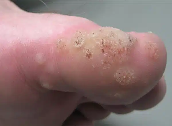 Close-up of a plantar wart on the side of a patient's big toe being examined, highlighting the need for professional removal at Michigan Foot Doctors.