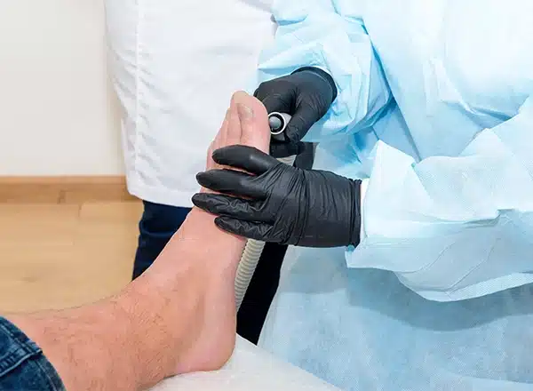 Wart Removal FOOT WITH A DOCTOR