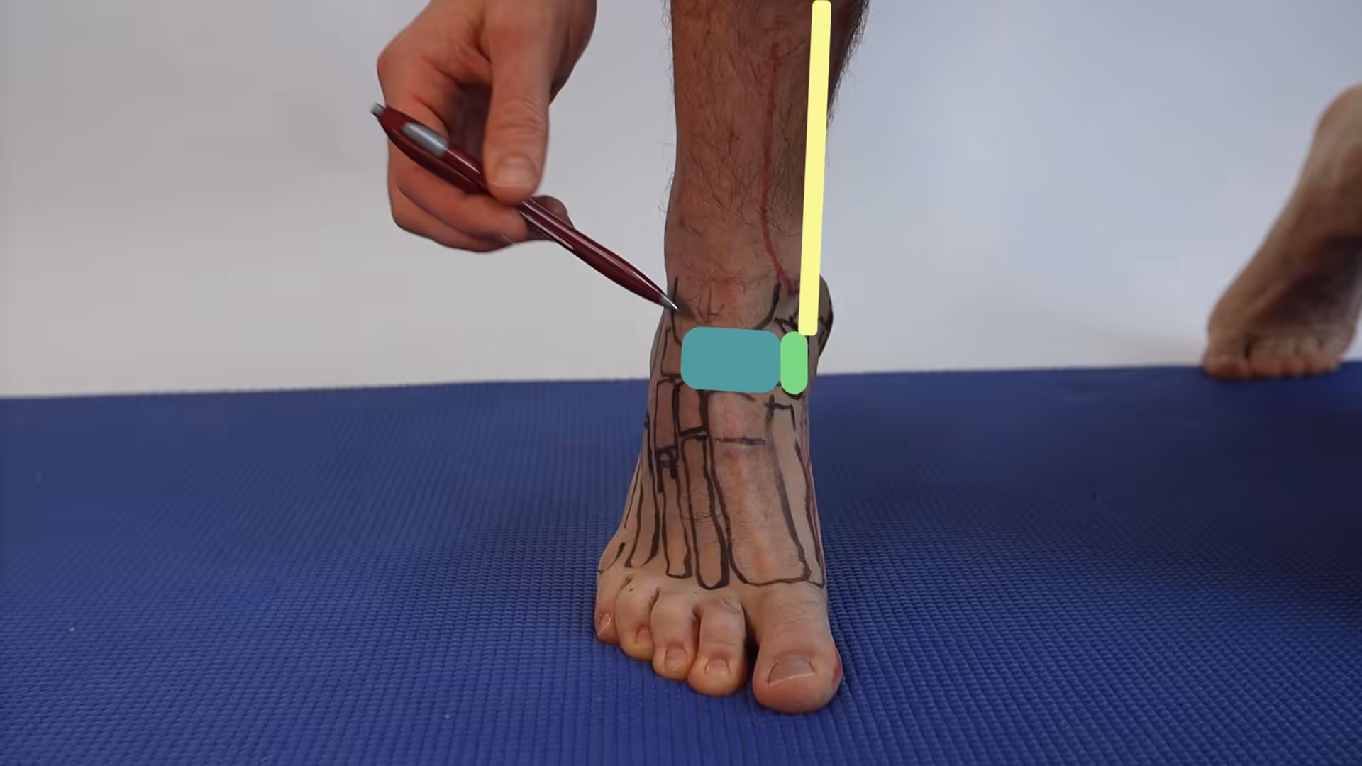 Accessory Navicular Ap Anatomy - Balance Foot & Ankle