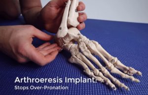 Arthroeresis implant for subtalar joint overpronation