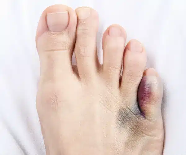Broken Pinky Toe (2) | Balance Foot & Ankle