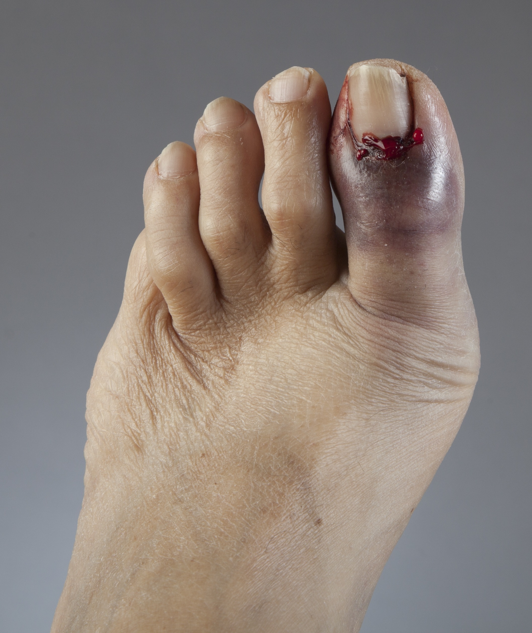 Fractured Hallux Stubbed Big Toe Or Broken Big Toe Best Treatment