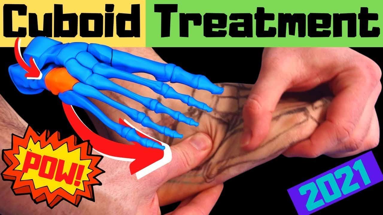 cuboid syndrome treatment