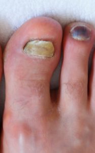 Black Toenail Falling Off 3 Right big toe nail fungus with right 2nd toe blood.