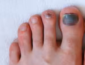 Bruise Under the Big Toenail 2026: Causes & Best Treatment 1 Bruise Under the Big Toenail Treatment: Causes & Symptoms.